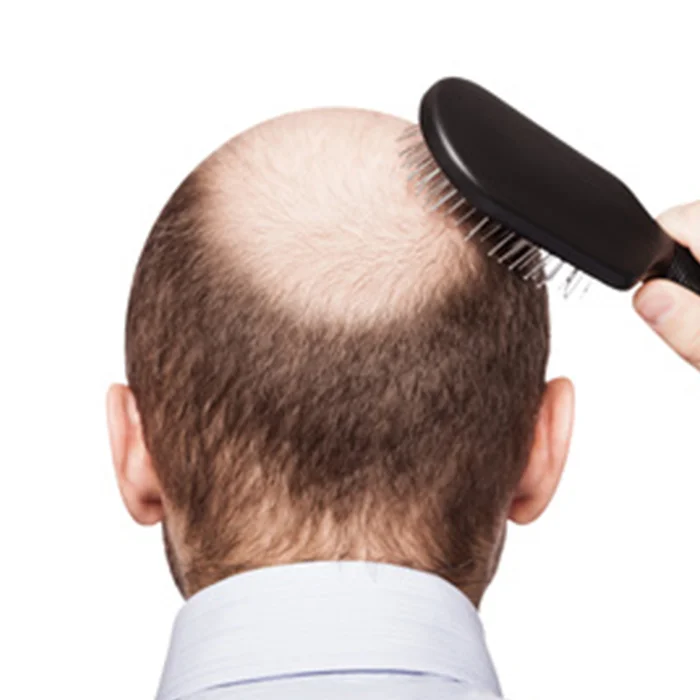 About Hair Loss
