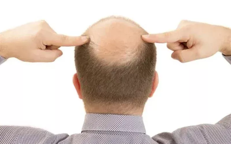 Hair Transplant