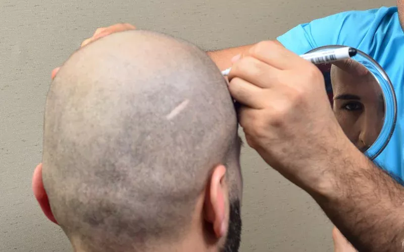 hair transplant