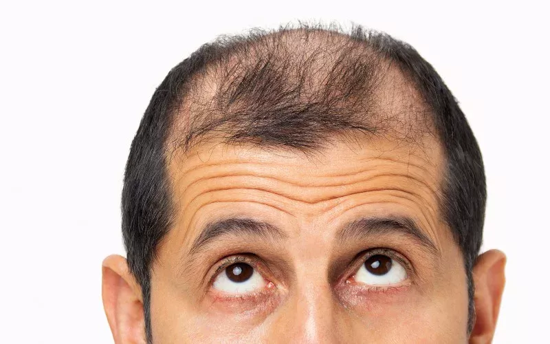 hair transplant