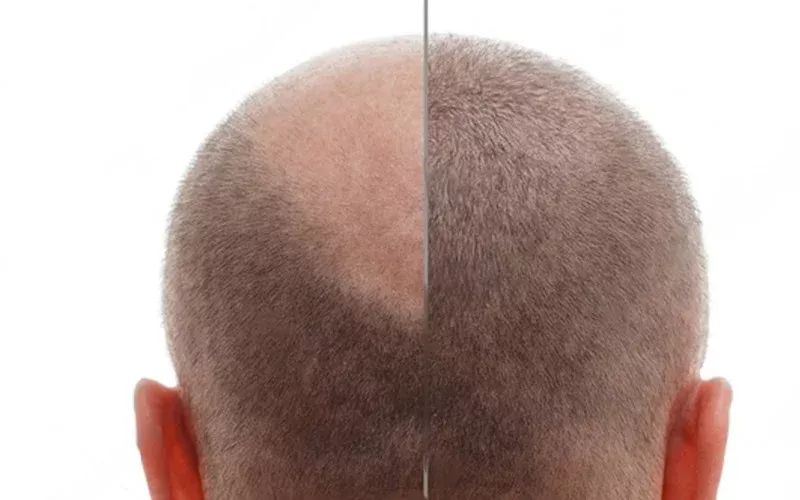 Hair Transplant