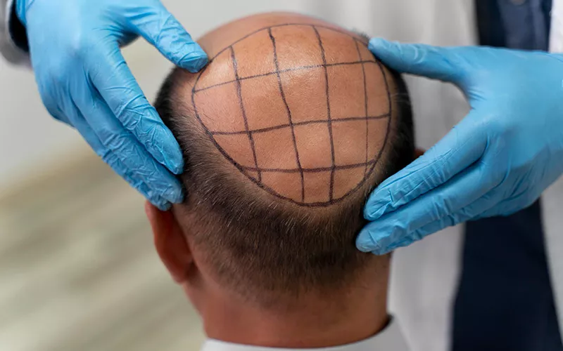 hair transplant