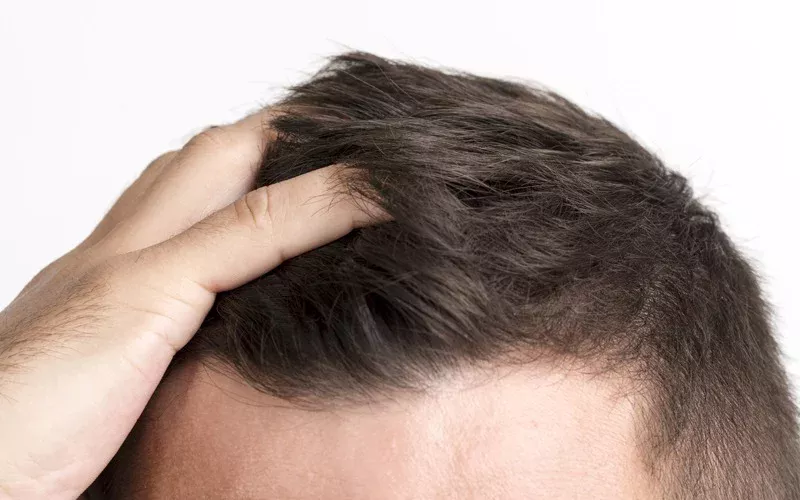 hair transplant