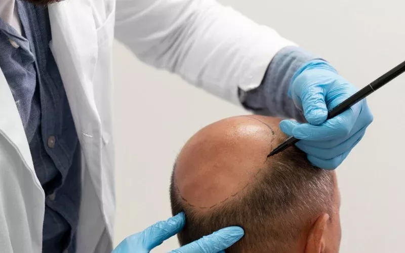 hair transplant