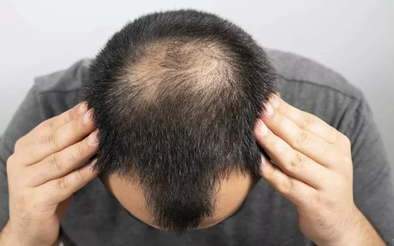 hair transplant