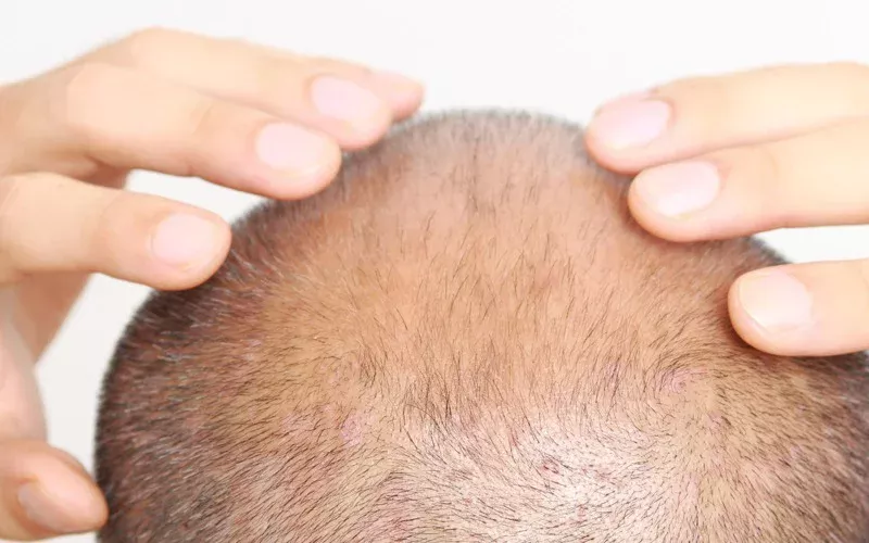 hair transplant