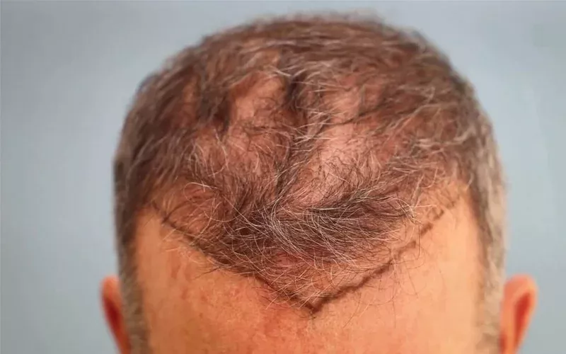 hair transplant