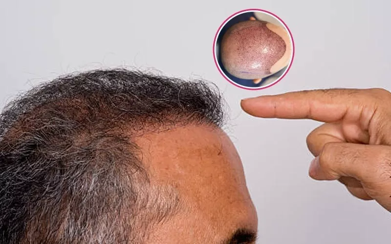 Hair Transplant