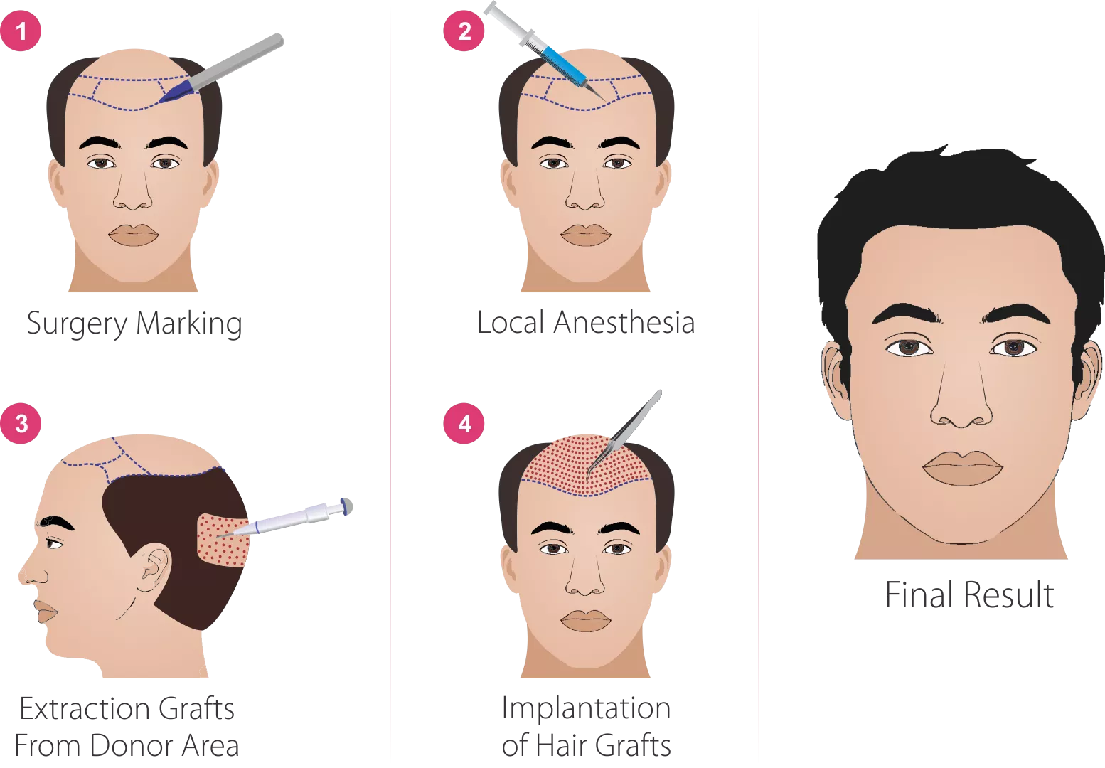 hair transplant