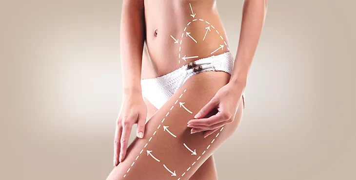 liposuction