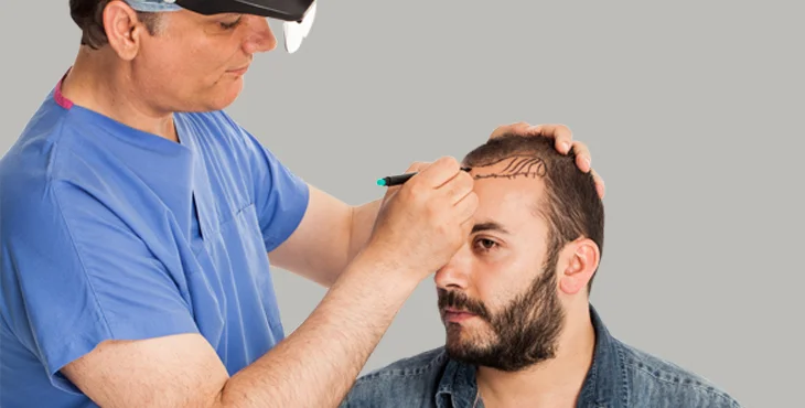 Bio-DHI Hair Transplant