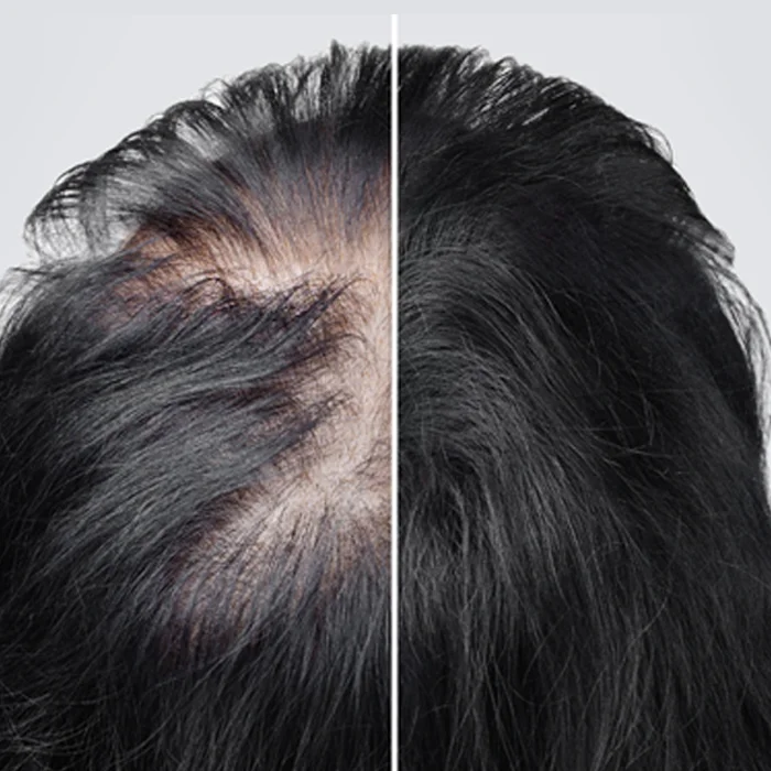 Female Hair restoration