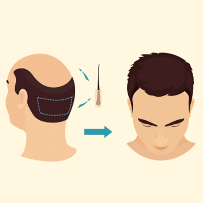 Follicular Unit Extraction