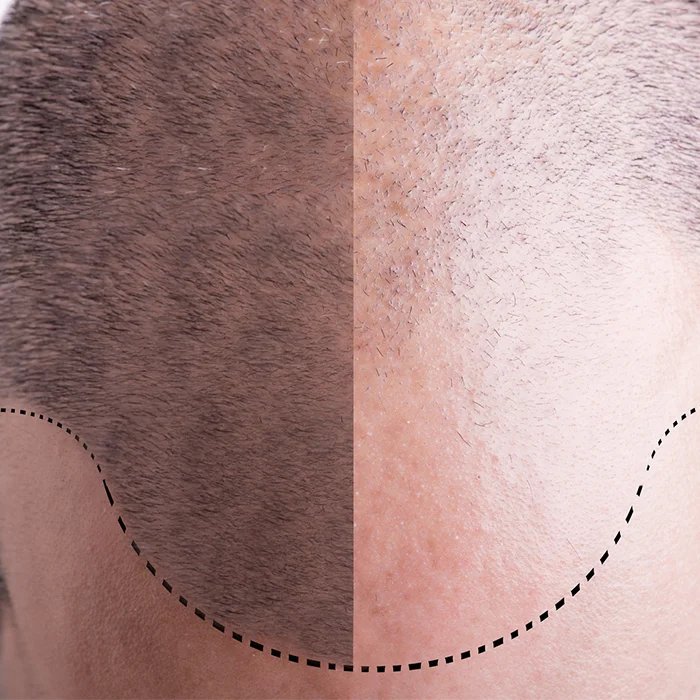 Male Hair restorationation