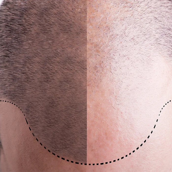 Male Hair Transplantation