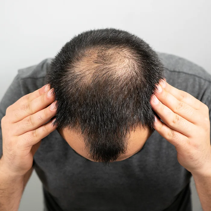 Male Hair Loss