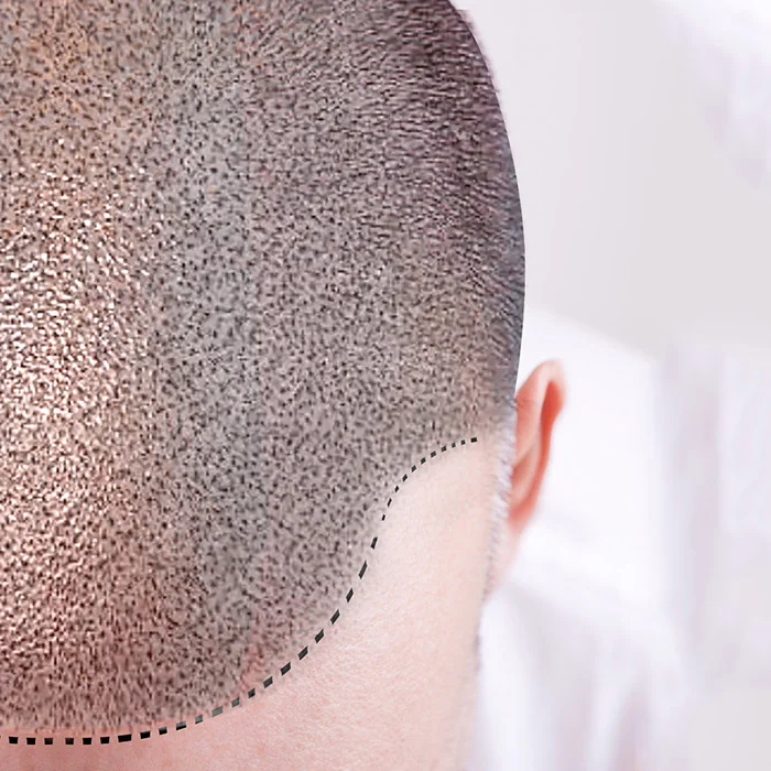 Scalp Micropigmentation Treatment