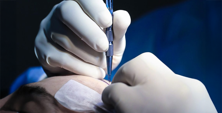 Bio-DHT Hair restoration